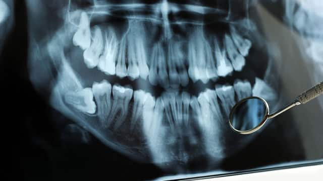 Come curarsi dopo l’estrazione dei denti del giudizio