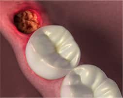 Alveolite secca dopo l'estrazione di un dente del giudizio