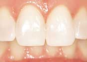 After_whitening